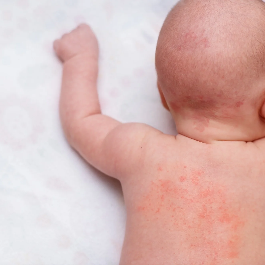 Atopic Dermatitis or Eczema in Childern
