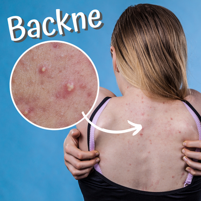 What is “Backne?  and how to defeat it. Naos Care