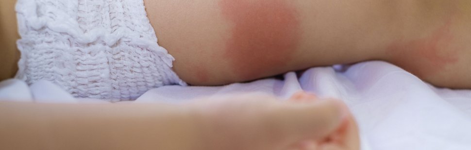 Atopic dermatitis in children's skin: Everything about your child's atopic skin